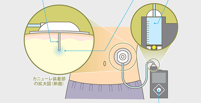 インスリンポンプ療法とは？