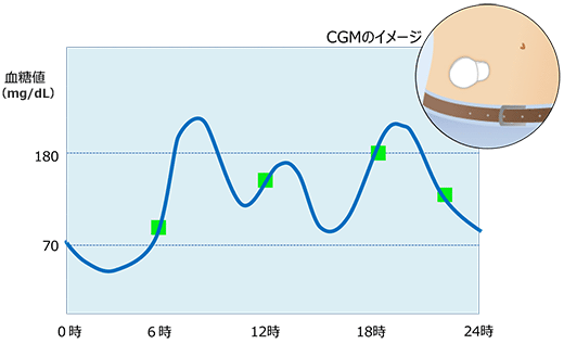 CGM （持続グルコースモニタ）のイメージ