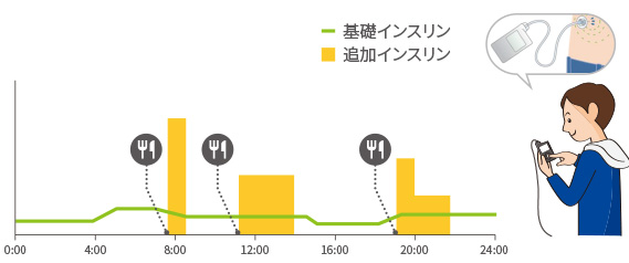 インスリンポンプによるコントロール